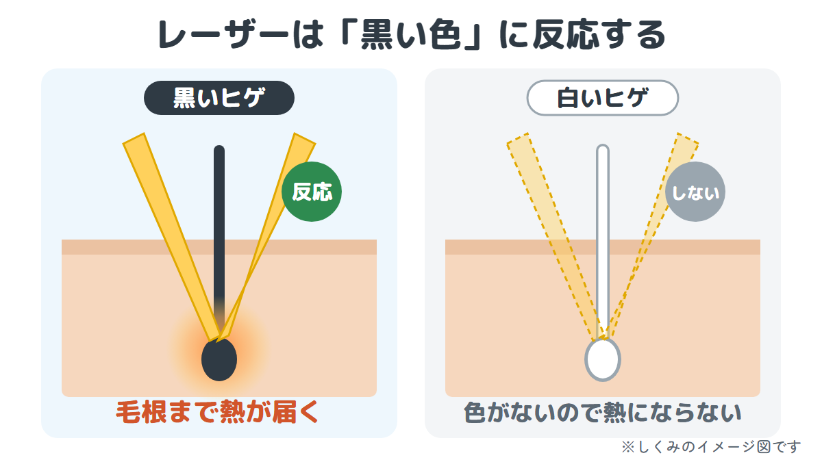 レーザーは黒いヒゲには反応して毛根まで熱が届くが、白いヒゲには反応しないことを表したイメージ図
