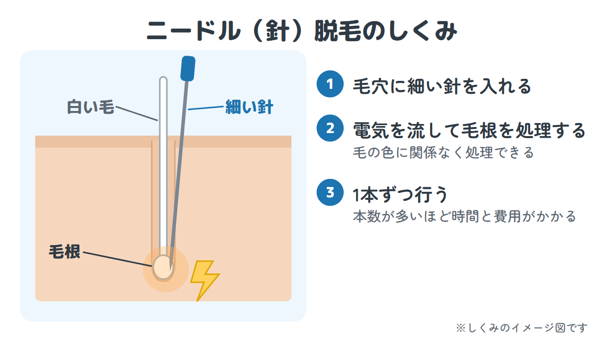 ニードル脱毛のしくみ。毛穴に細い針を入れ、電気を流して毛根を処理するイメージ図